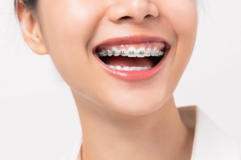 How Much Do Braces Cost? Braces Price Hornsby Dental