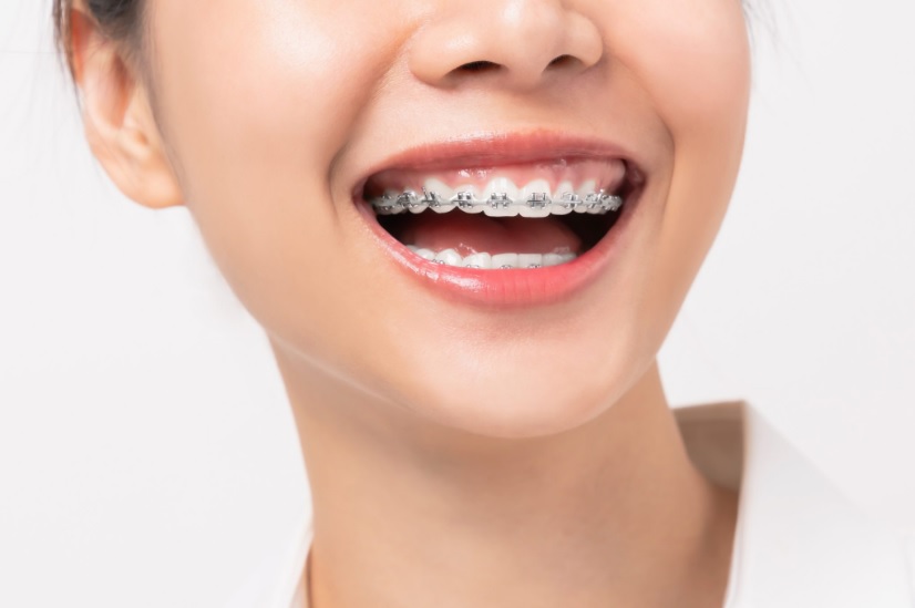 How Much Do Braces Cost? Braces Price Hornsby Dental