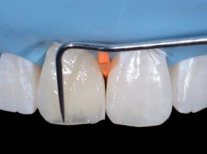 Composite Veneers Cost