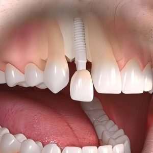 Dental Implants Near Me