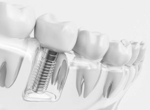 Dental Implants Sydney