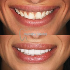 Dental Veneers Before and After