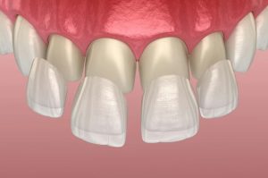 Porcelain Veneers Cost