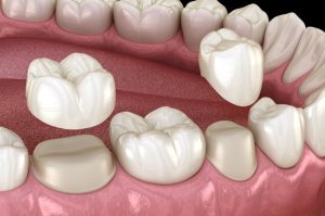 Dental Crown Cost