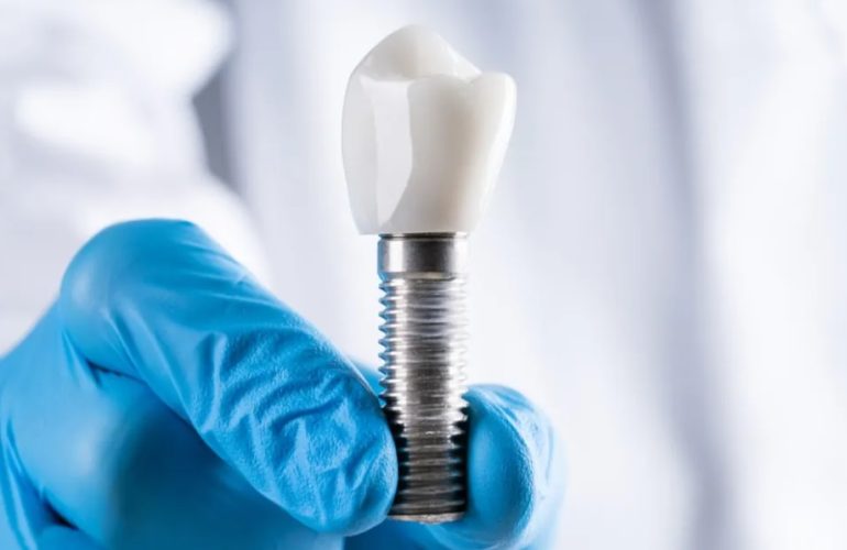 Dental Implants Procedure