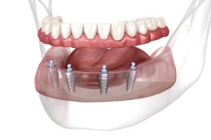 Dental Implants Procedure