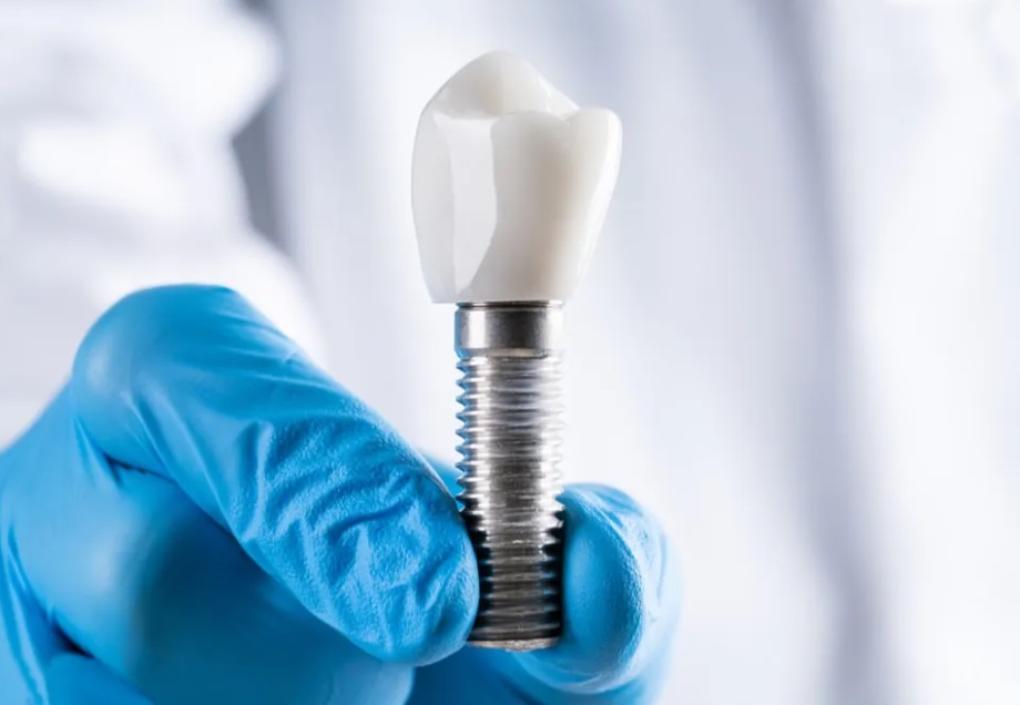 Dental Implants Procedure