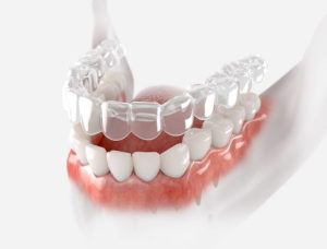 How Much Does Invisalign Cost